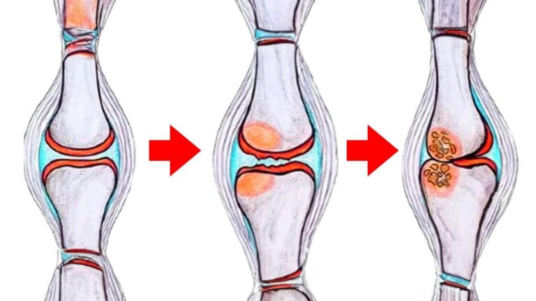 Cette méthode alimentaire transforme vos douleurs d&rsquo;arthrose en soulagement…