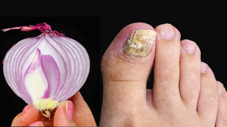 Cette méthode naturelle fait disparaître le mycose des ongles en un rien de temps…