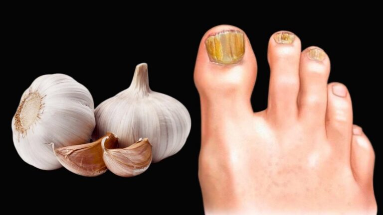 Cette vieille astuce à base d&rsquo;ail élimine le champignon des ongles en un rien de temps…