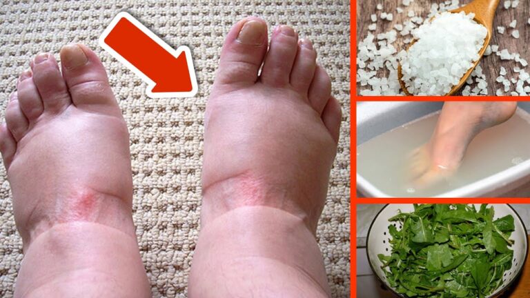 6 remèdes naturels surprenants pour réduire les pieds gonflés !