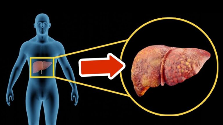 5 symptômes de la cirrhose du foie à ne jamais ignorer pour ta santé !