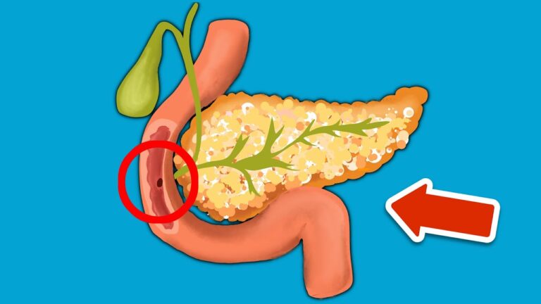 5 signes à reconnaître d&rsquo;une pancréatite pour protéger votre santé !