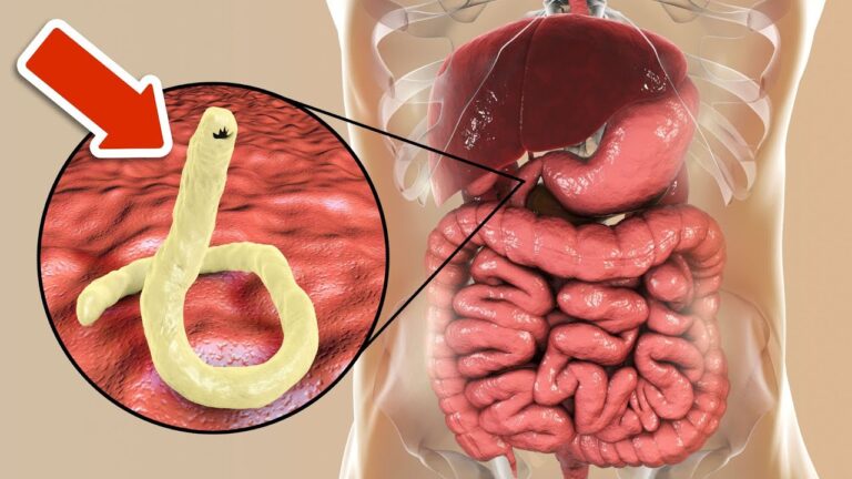 Éliminez 4 parasites intestinaux rapidement avec ces remèdes naturels et simples !