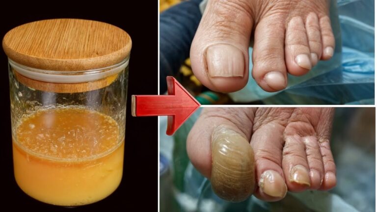 6 astuces naturelles pour dire adieu aux mycoses des ongles et avoir des ongles sains !